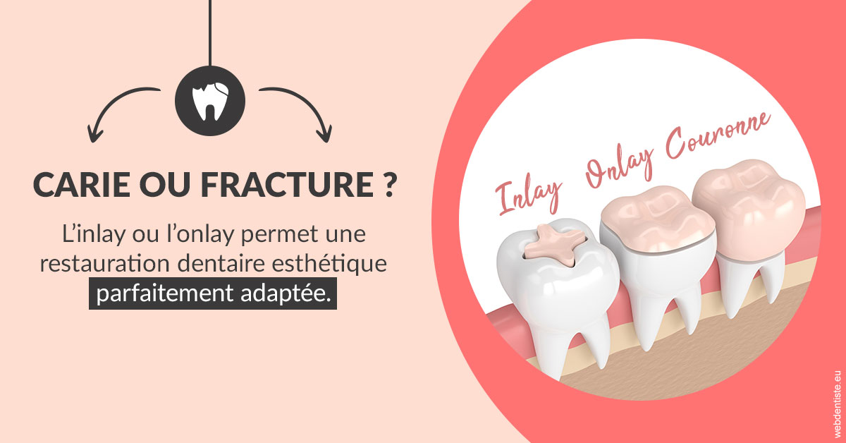 https://scp-benkimoun-lafont-roussarie.chirurgiens-dentistes.fr/T2 2023 - Carie ou fracture 2