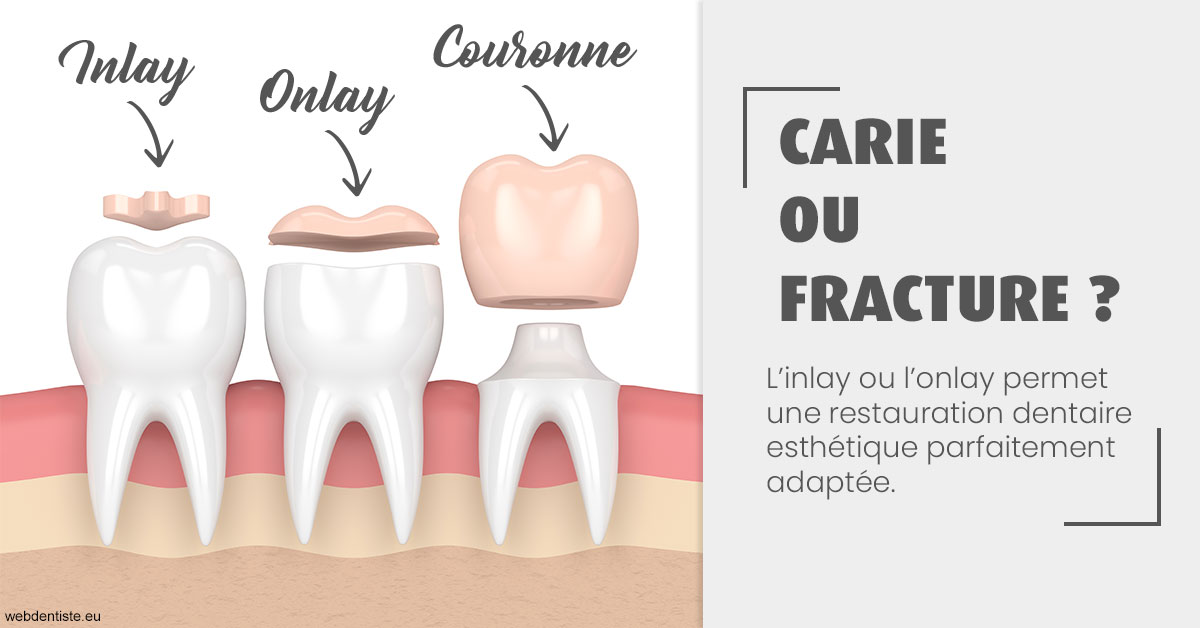 https://scp-benkimoun-lafont-roussarie.chirurgiens-dentistes.fr/T2 2023 - Carie ou fracture 1