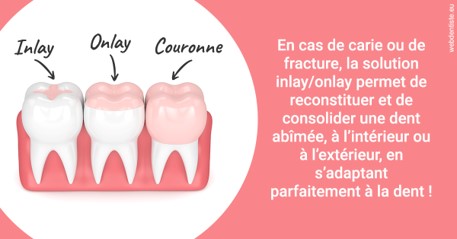 https://scp-benkimoun-lafont-roussarie.chirurgiens-dentistes.fr/L'INLAY ou l'ONLAY 2