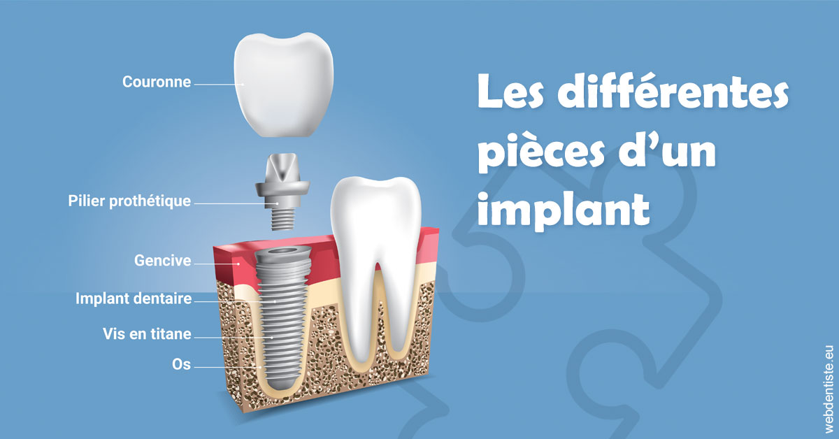https://scp-benkimoun-lafont-roussarie.chirurgiens-dentistes.fr/Les différentes pièces d’un implant 1